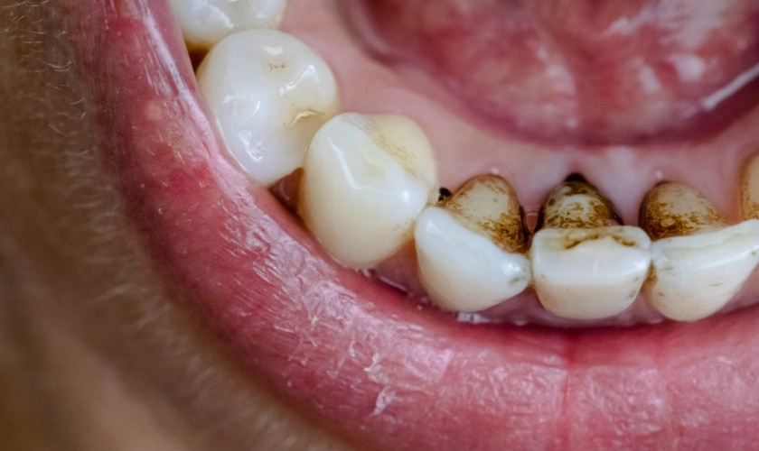 remove black stains from my teeth