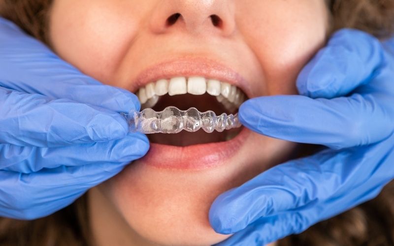 questions to ask your invisalign dentist