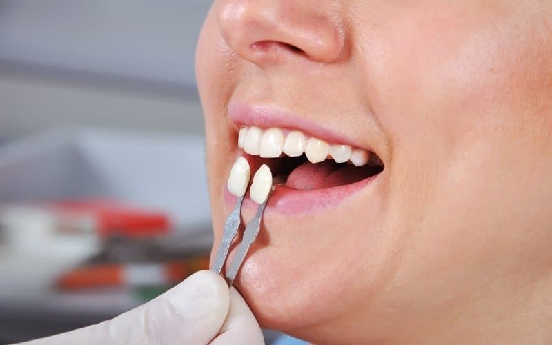 the truth about dental veneers debunking common myths