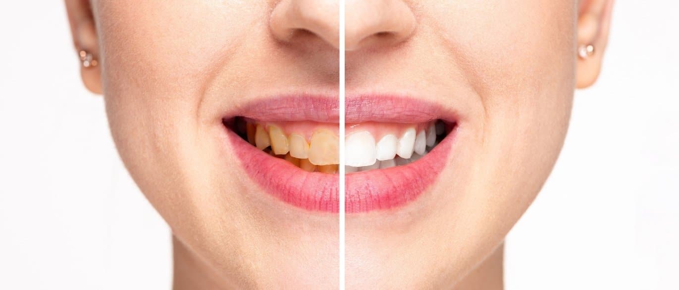 can teeth whitening help with age-related yellowing