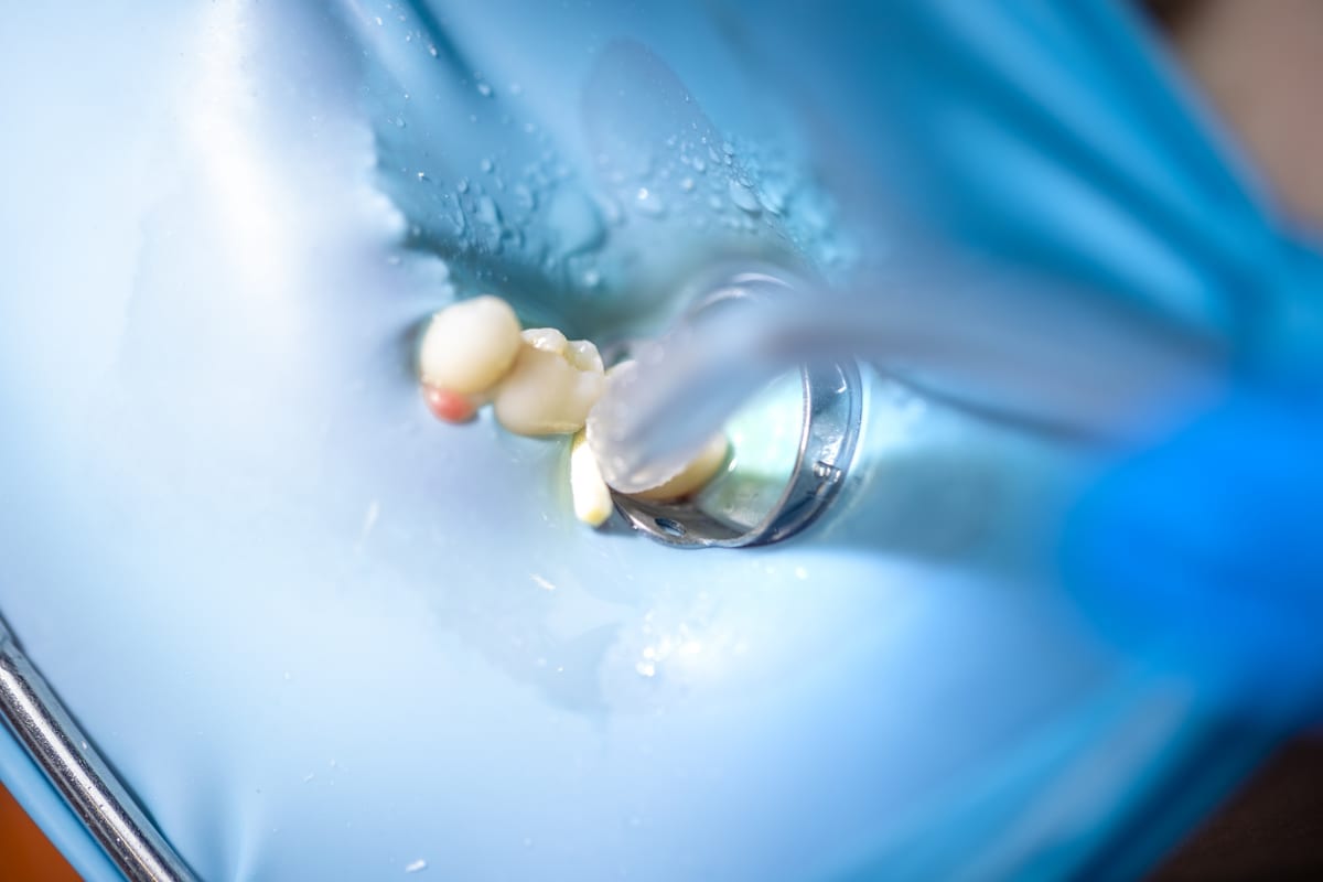 Root Canal Treatment in El Segundo