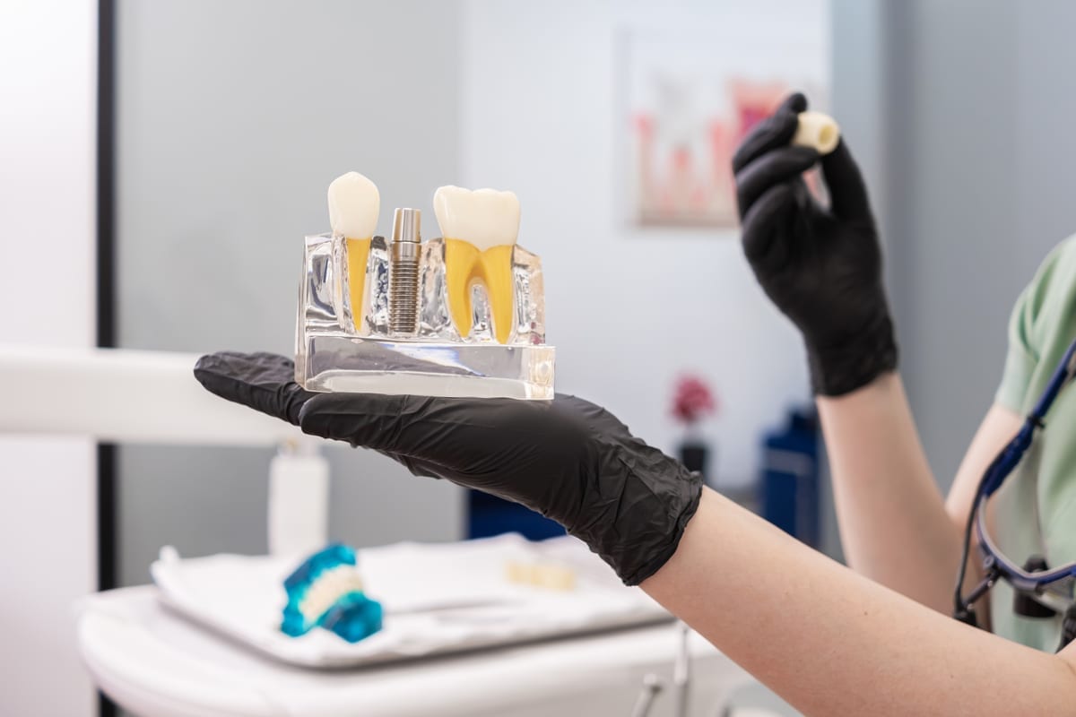 Dental Crowns in Los Angeles