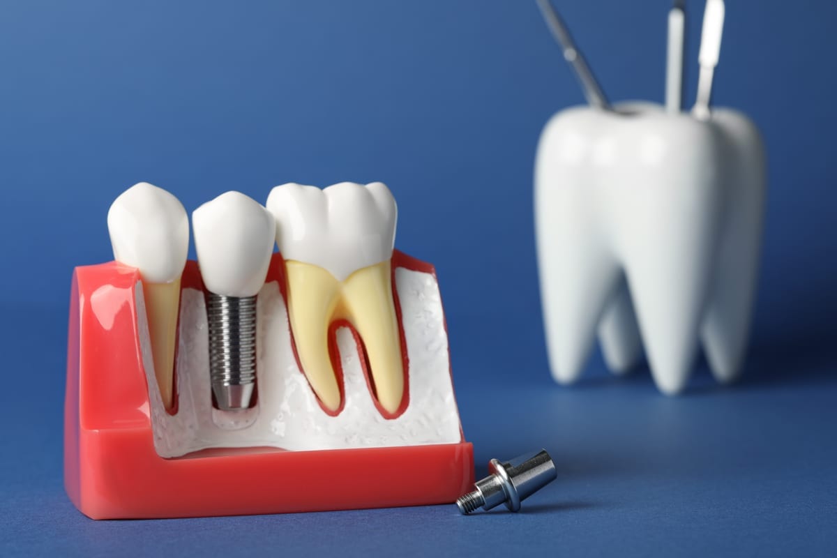 Dental Implants in El Segundo